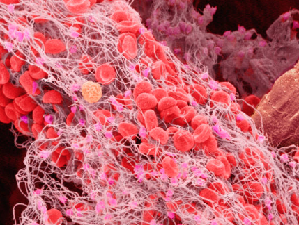 3D graphic of a blood clot, which looks liek a tangle of fibers and red blood cells.